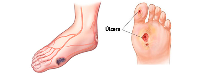 Úlceras en el pie diabético